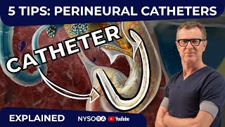 5 TIPS PERINEURAL CATHETERS  Crash course with Dr Hadzic [upl. by Libove]