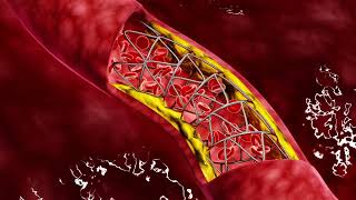 Carotid Artery Disease CAD [upl. by Nnylav859]