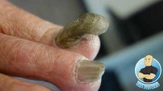 RAMS HORN 4 YEARS WITHOUT BEING CUT EXTREME TOENAIL CUTTING OF A THICK NAIL [upl. by Assek]