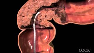 Evolution® Colonic ControlledRelease Stent  Uncovered Endoscopic Animation [upl. by Michaele]