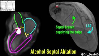 Hypertrophic Cardiomyopathy [upl. by Adnarom]