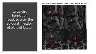 Regenexx MRI Before After Compliation Video [upl. by Licec463]