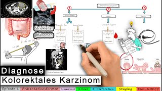 kolorektales Karzinom Ep 13 Diagnose [upl. by Satterfield408]