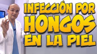 INFECCIÓN POR HONGOS EN LA PIEL  Todo lo que necesita saber [upl. by Novyad719]