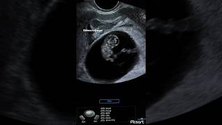 8 weeks fetus subchorionic hemorrhage peri sac hematoma ultrasound ardms sonography radiology [upl. by Aicenet]