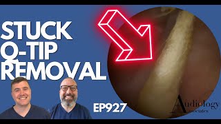 STUCK QTIP REMOVAL FROM EAR  EP927 [upl. by Ahsekat]