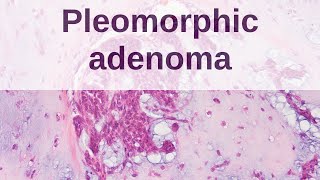 Pleomorphic Adenoma of Salivary Gland [upl. by Orabelle]