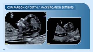 Measuring Nuchal Translucency and Crown Rump Length 12–13 weeks scan [upl. by Adnulahs269]