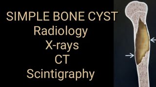 Simple bone cyst Radiology x ray CT and Scintigraphy [upl. by Neyuq]