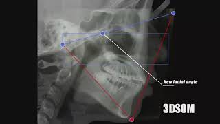 3DSOM ORTHODONTIC Non extraction case of Bimaxillary protrusion [upl. by Acissj]