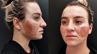 Removing Dark Spots in 7 Days 100 Natural  Acne Scars  Shellyposh Lifestyle [upl. by Marsden]