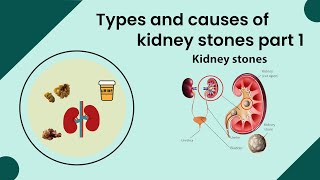 Types and causes of kidney stones part 1 Kidney stone symptoms Kidney stone treatment Kidney diet [upl. by Nailluj]