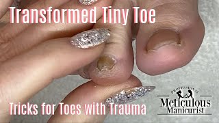 Ingrown Tiny Thick Toenails Pedicure Transformation [upl. by Erreipnaej220]