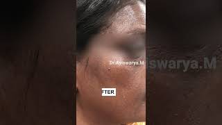 Pigmentation Treatment on Face  Before amp After sikhiskinclinic shorts ytshorts pigmentation [upl. by Tama]