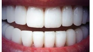 DENTS BLANCHES EN SEULEMENT 3 MINUTES [upl. by Alaaj]