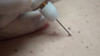 Hyperkeratosis removal with Plexr [upl. by Ahtoelc658]