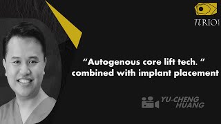 “Autogenous core lift tech ” combined with implant placement [upl. by Amla]