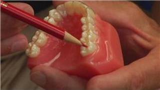 Tooth amp Gum Abscesses  How Dentists Drain an Abscessed Tooth [upl. by Nwahsal]