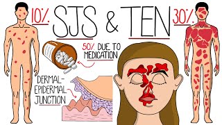 Understanding StevensJohnson Syndrome and Toxic Epidermal Necrolysis SJS amp TEN [upl. by Eugenius]