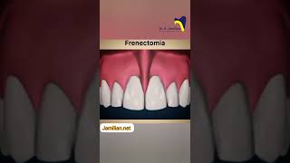 Frenectomy and diastema dentist bracing orthodontics [upl. by Holihs165]