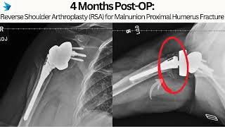 Case Presentation Reverse Shoulder Arthroplasty for Proximal Humerus Malunion [upl. by Namie]