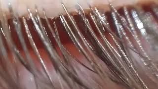 Removing Demodex on my eyelashes 4 [upl. by Susana39]