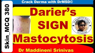 DARIERS SIGN  Mastocytosis  Urticaria Pigmentosa  Wheal  Histamine  Dermographism  DrMSD [upl. by Alyled545]