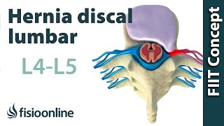 Hernia discal lumbar entre la L4 y L5 o cuarta y quinta vértebras lumbares [upl. by Kampmann]