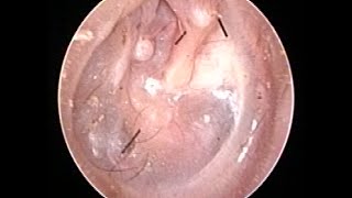 Otoendoscopy  Retracted Ear Drum [upl. by Areem]