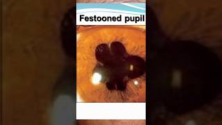 Festornal pupil  post synechiea  IMSC RE NS2 Disc amp macula normal Adv phaco PC IOL [upl. by Inittirb]