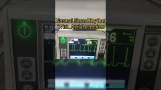 Normal Sinus Rhythm with Atrial Ectopic beats ecg cardiology [upl. by Tomkiel655]