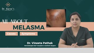 Melasma pigmentation Explained by the Skin Doctor [upl. by Adialeda]