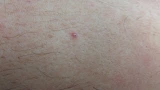 Encapsulated Ingrown Hairs [upl. by Einapets]