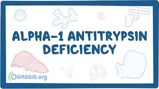 Alpha1 Antitrypsin Deficiency  causes symptoms diagnosis treatment pathology [upl. by Treboh130]