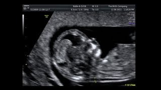 Nuchal Translucency Scan 11 Weeks  14 Weeks [upl. by Roux]