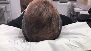 Scalp Micropigmentation Before and After [upl. by Aim867]