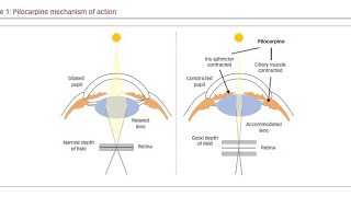 Using Muscarinic Agonist drugs Pilocarpine to treat Glaucoma [upl. by Maximo]