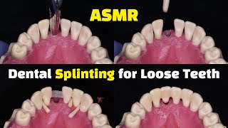 Dental Splinting for Loose Teeth using Ribbond after a Tooth Extraction [upl. by Anreval51]