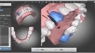 Estudo de Caso com DentOne entendendo o quotModelerquot e os Princípios do quotEstagiamento 4x4quot Bacci [upl. by Nhguaval]