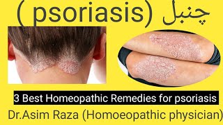 3 Best Homeopathic medicine for psoriasis  Dr Asim Raza Homoeopathic physician [upl. by Isherwood]