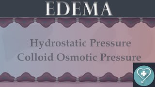 Edema  Pathogenesis of edema  Pathology  Animated lecture [upl. by Ellessig390]