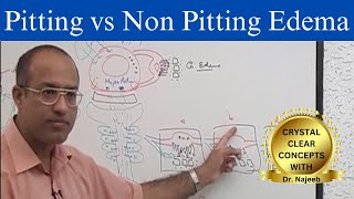 Edema  Pitting vs Non Pitting Edema [upl. by Aicela]