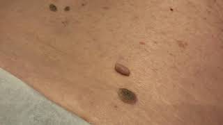 Skin Tag Removal using our CryoPen™ [upl. by Treblig]