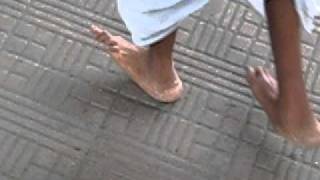 Talipes Calcaneus Deformity Walking Video [upl. by Aleet]