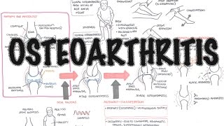 Osteoarthritis Overview causes pathophysiology investigations treatment [upl. by Wahkuna]