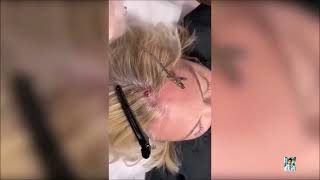 Ultimate Pimple Popping 2024 Fascinating Zit Extractions [upl. by Nazay]