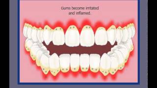 Progression of Gum Disease animation from the American Academy of Periodontology [upl. by Nady]