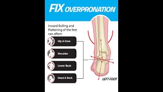 FIX YOUR OVERPRONATION SHORTS [upl. by Hazaki]