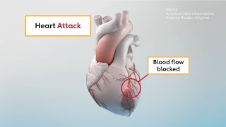 The differences between heart attack and cardiac arrest [upl. by Arvie930]