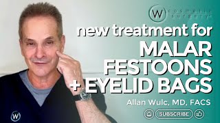 New Treatment for Malar Festoons and Big Eyelid Bags [upl. by Nahsaj]